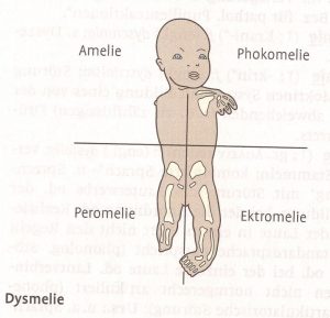 Abbildung Baby mit Dysmelie